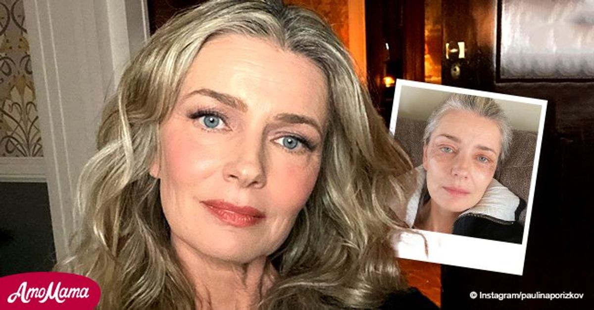 Paulina Porizkova Shares a Candid Selfie Showing Marks on Her Face from(01)