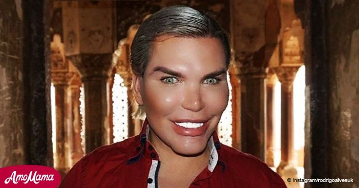 This is what the 'Human Ken Doll' looked like before surgery