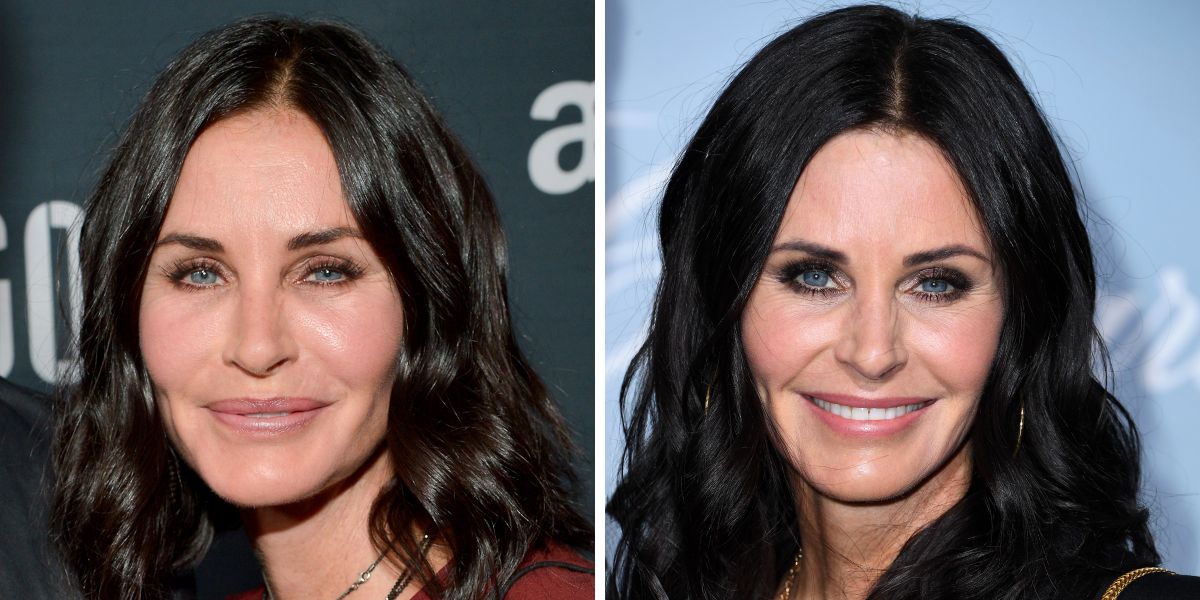 11 Celebrities Who Dissolved Their Fillers or Stopped Getting Them 30(01)