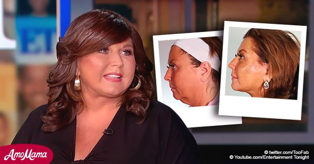 Abby Lee Miller Talks Undergoing Her Facelift While Awake