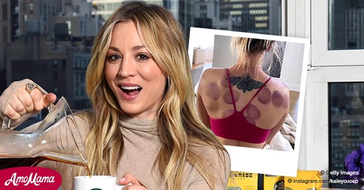 See Kaley Cuoco's Massive Cupping Marks as She Shares Snapshot of Her Back