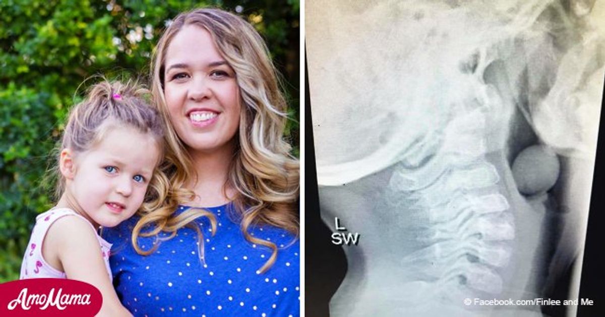 Terrifying Xray of grape stuck in child's throat goes viral as a
