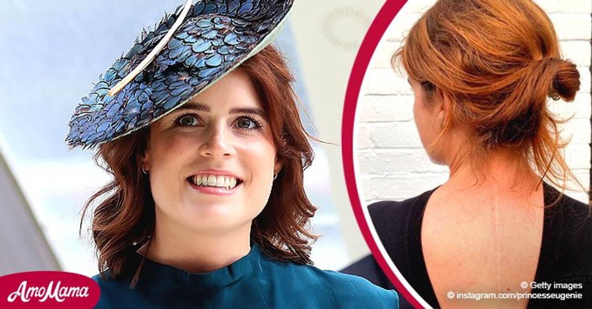 Princess Eugenie Shares Photo of Her Scar to Encourage People on